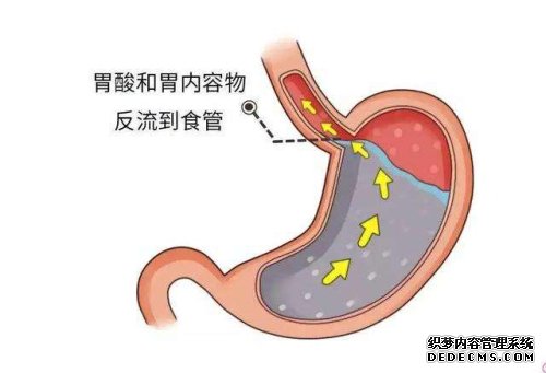 胃食管反流的飲食建議